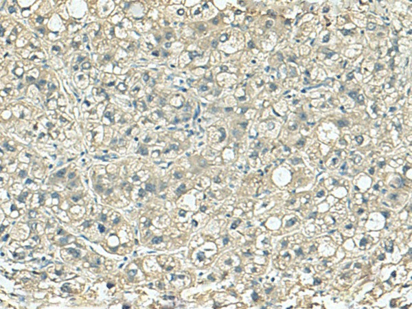 Immunohistochemistry of paraffin-embedded Human liver cancer tissue  using SORBS2 Polyclonal Antibody at dilution of 1:120(?200)