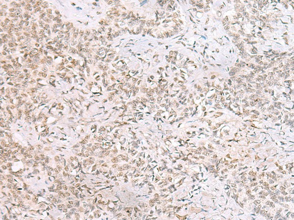 Immunohistochemistry of paraffin-embedded Human ovarian cancer tissue  using SMNDC1 Polyclonal Antibody at dilution of 1:50(?200)