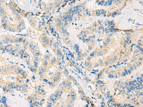 Immunohistochemistry of paraffin-embedded Human thyroid cancer tissue  using SYNGR1 Polyclonal Antibody at dilution of 1:50(?200)