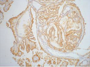 Immunohistochemistry of paraffin-embedded Human thyroid tissue using Galectin 3 Monoclonal Antibody at dilution of 1:200.