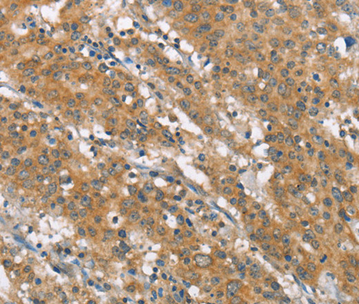 Immunohistochemistry of paraffin-embedded Human gasrtic cancer tissue using NLRP7 Polyclonal Antibody at dilution 1:40