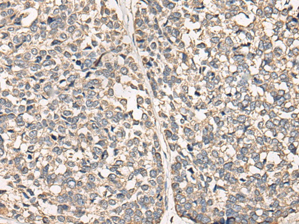 Immunohistochemistry of paraffin-embedded Human esophagus cancer tissue  using C12orf40 Polyclonal Antibody at dilution of 1:50(?200)