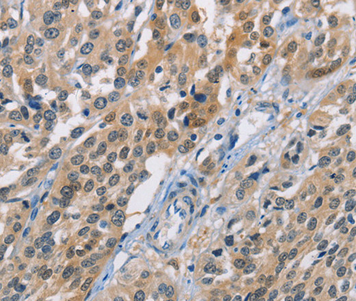 Immunohistochemistry of paraffin-embedded Human esophagus cancer using CBR1 Polyclonal Antibody at dilution of 1:40