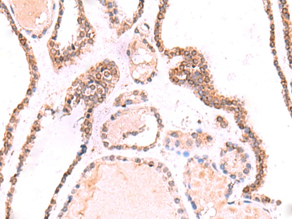 Immunohistochemistry of paraffin-embedded Human thyroid cancer tissue  using TOR1AIP1 Polyclonal Antibody at dilution of 1:70(?200)