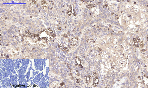 Immunohistochemistry of paraffin-embedded Human lung cancer tissue using CD45 Monoclonal Antibody at dilution of 1:200.