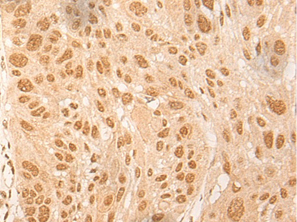 Immunohistochemistry of paraffin-embedded Human esophagus cancer tissue  using DBP Polyclonal Antibody at dilution of 1:25(?200)