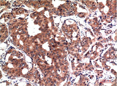 Immunohistochemistry of paraffin-embedded Human breast carcinoma tissue using GSK3 beta Monoclonal Antibody at dilution of 1:200.