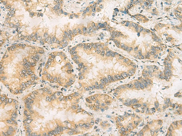 Immunohistochemistry of paraffin-embedded Human lung cancer tissue  using RAB13 Polyclonal Antibody at dilution of 1:50(?200)