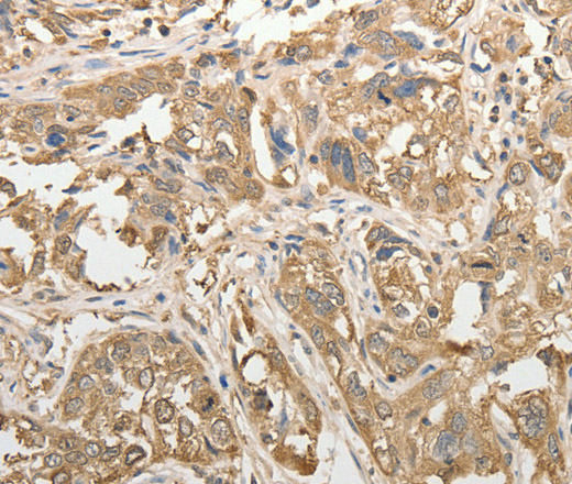 Immunohistochemistry of paraffin-embedded Human esophagus cancer tissue using ADHFE1 Polyclonal Antibody at dilution 1:50