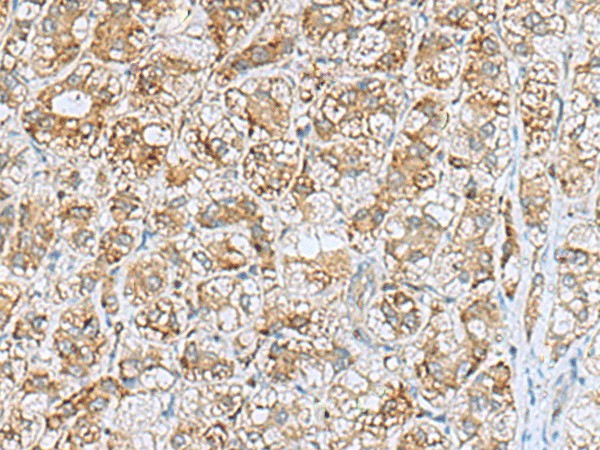 Immunohistochemistry of paraffin-embedded Human liver cancer tissue  using NQO2 Polyclonal Antibody at dilution of 1:70(?200)