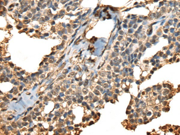 Immunohistochemistry of paraffin-embedded Human ovarian cancer tissue  using PHF21A Polyclonal Antibody at dilution of 1:50(?200)