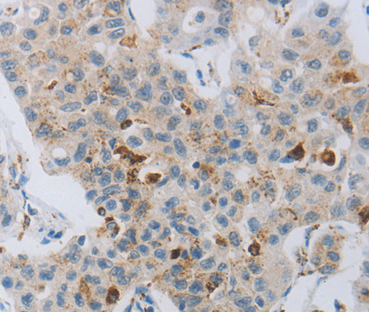 Immunohistochemistry of paraffin-embedded Human lung cancer tissue using CKMT1A Polyclonal Antibody at dilution 1:100