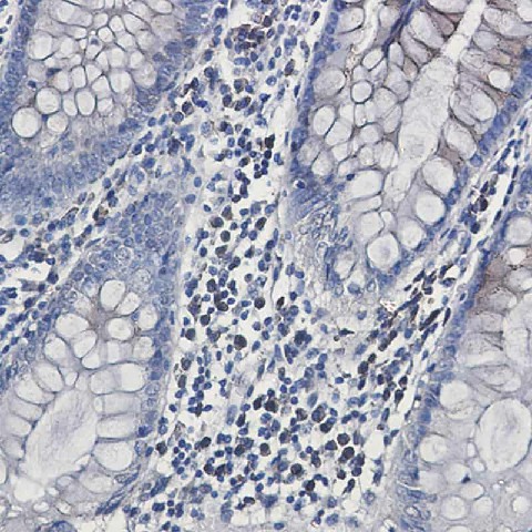 Immunohistochemistry of CLSTN1 in paraffin-embedded Human colon cancer tissue using CLSTN1 Rabbit mAb at dilution 1:50