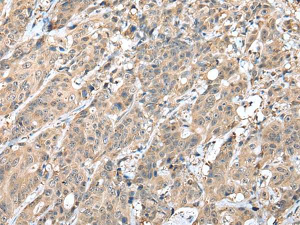 Immunohistochemistry of paraffin-embedded Human colorectal cancer tissue  using HIF1A Polyclonal Antibody at dilution of 1:45(?200)