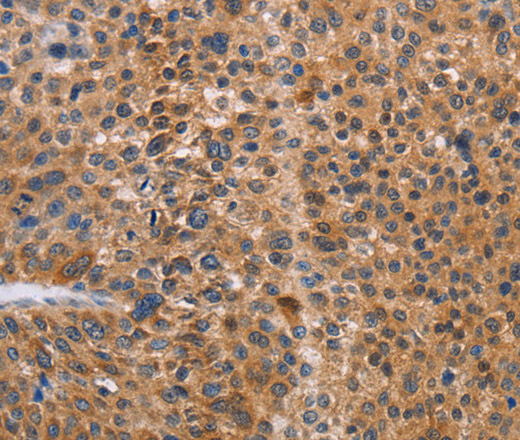 Immunohistochemistry of paraffin-embedded Human liver cancer tissue using NIF3L1 Polyclonal Antibody at dilution 1:30