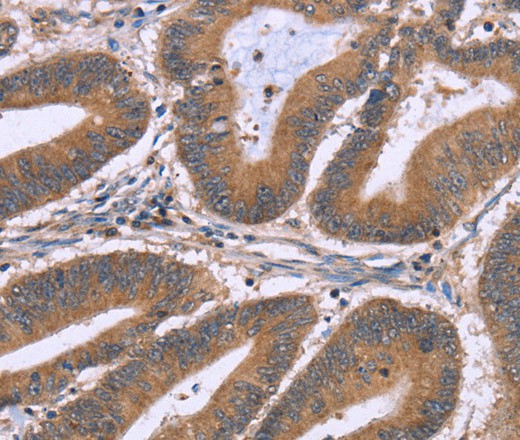 Immunohistochemistry of paraffin-embedded Human colon cancer using NRG1 Polyclonal Antibody at dilution of 1:40