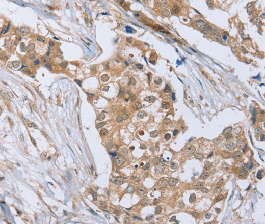 Immunohistochemistry of paraffin-embedded Human breast cancer tissue using RAB8B Polyclonal Antibody at dilution 1:45