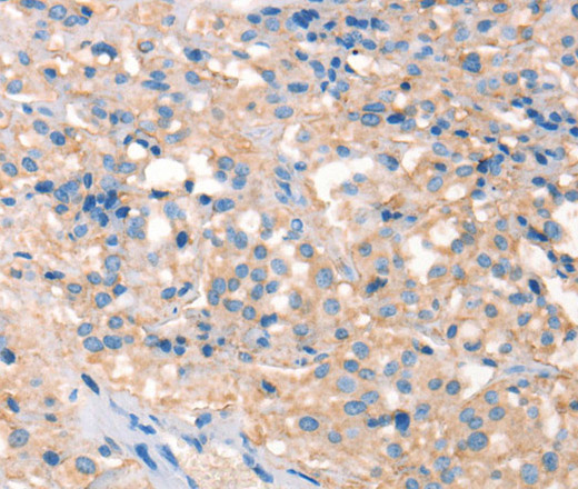 Immunohistochemistry of paraffin-embedded Human thyroid cancer using PRPS1/2/PRPS1L1 Polyclonal Antibody at dilution of 1:30