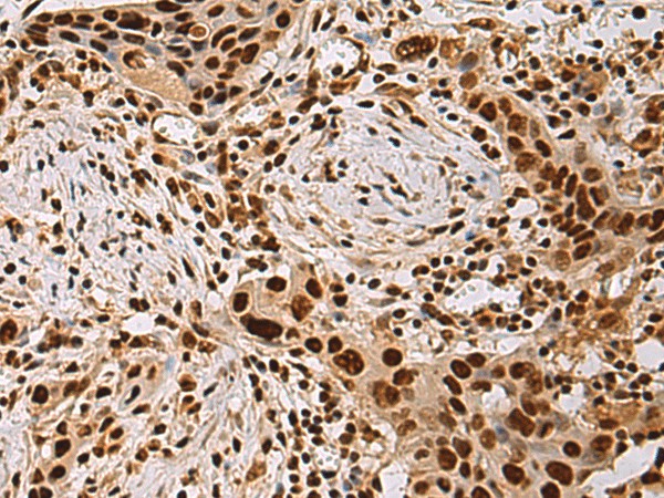 Immunohistochemistry of paraffin-embedded Human esophagus cancer tissue  using HDAC1 Polyclonal Antibody at dilution of 1:45(?200)