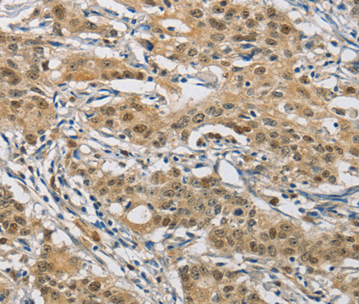 Immunohistochemistry of paraffin-embedded Human gastric cancer using NAPSA Polyclonal Antibody at dilution of 1:50