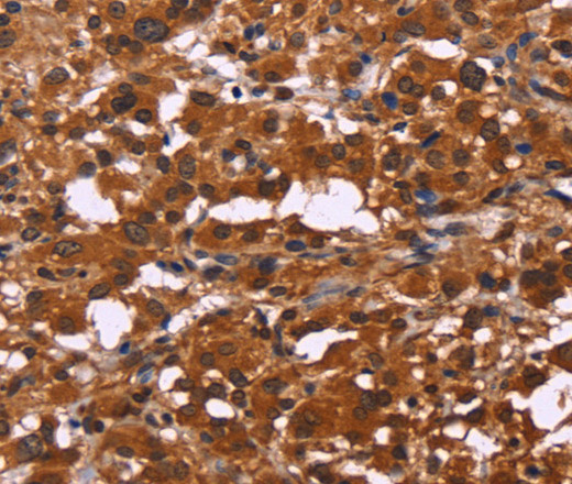 Immunohistochemistry of paraffin-embedded Human thyroid cancer tissue using ART5 Polyclonal Antibody at dilution 1:50