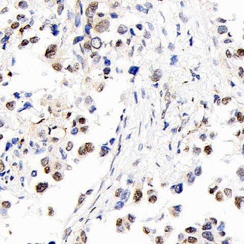 Immunohistochemistry analysis of paraffin-embedded human lung cancer  using S100A4 Polyclonal Antibody at dilution of 1:400.