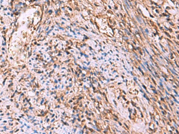 Immunohistochemistry of paraffin-embedded Human cervical cancer tissue  using RHAG Polyclonal Antibody at dilution of 1:130(?200)