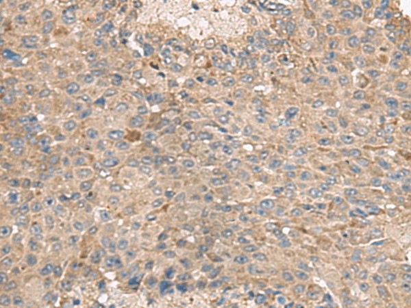 Immunohistochemistry of paraffin-embedded Human liver cancer tissue  using ABCA10 Polyclonal Antibody at dilution of 1:50(?200)