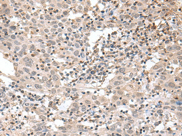 Immunohistochemistry of paraffin-embedded Human cervical cancer tissue  using TDP2 Polyclonal Antibody at dilution of 1:75(?200)