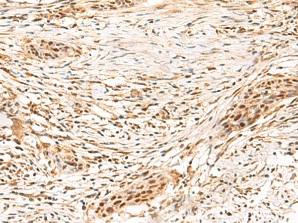 Immunohistochemistry of paraffin-embedded Human esophagus cancer tissue  using SETMAR Polyclonal Antibody at dilution of 1:100(?200)