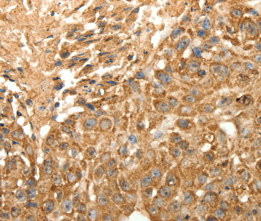 Immunohistochemistry of paraffin-embedded Human esophagus cancer using SLC25A11 Polyclonal Antibody at dilution of 1:30