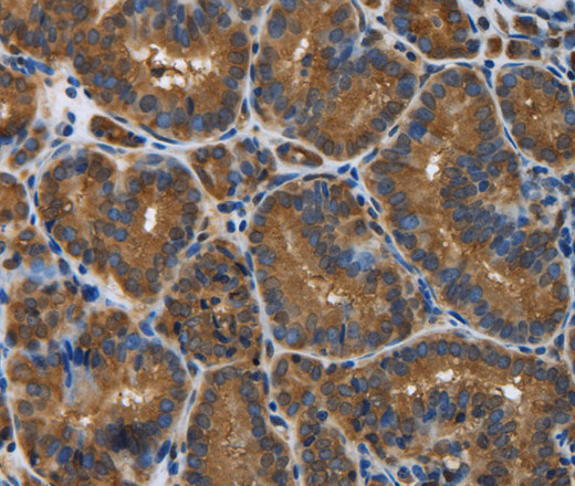 Immunohistochemistry of paraffin-embedded Human thyroid cancer tissue using SNCG Polyclonal Antibody at dilution 1:50