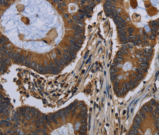 Immunohistochemistry of paraffin-embedded Human colon cancer tissue using FGF18 Polyclonal Antibody at dilution 1:40