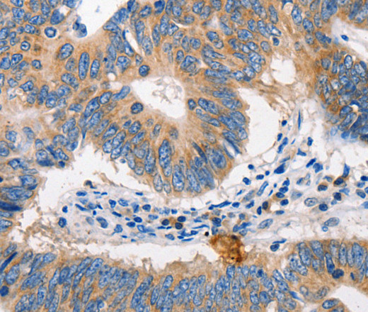 Immunohistochemistry of paraffin-embedded Human colon cancer tissue using MTOR Polyclonal Antibody at dilution 1:60