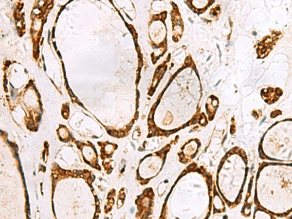 Immunohistochemistry of paraffin-embedded Human thyroid cancer tissue  using GRWD1 Polyclonal Antibody at dilution of 1:55(?200)