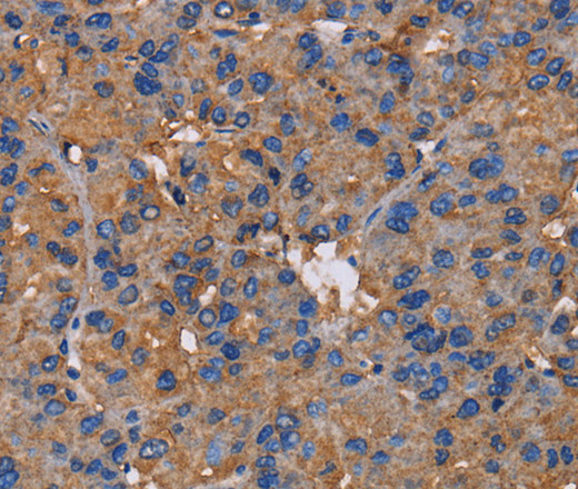 Immunohistochemistry of paraffin-embedded Human liver cancer tissue using NCSTN Polyclonal Antibody at dilution 1:50