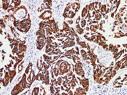 Immunohistochemistry of paraffinembedded Human lung squamous cell carcinoma with Cytokeratin Pan Monoclonal Antibody(Antigen repaired by EDTA).