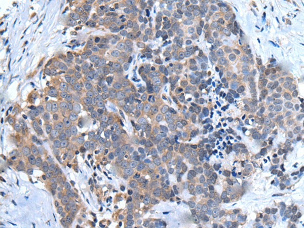 Immunohistochemistry of paraffin-embedded Human thyroid cancer tissue  using UBQLN2 Polyclonal Antibody at dilution of 1:45(?200)