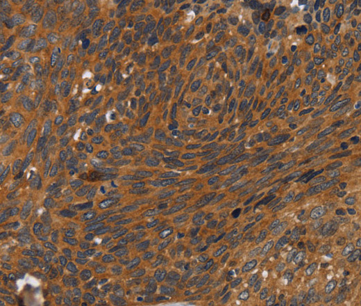 Immunohistochemistry of paraffin-embedded Human cervical cancer using CD116 Polyclonal Antibody at dilution of 1:35