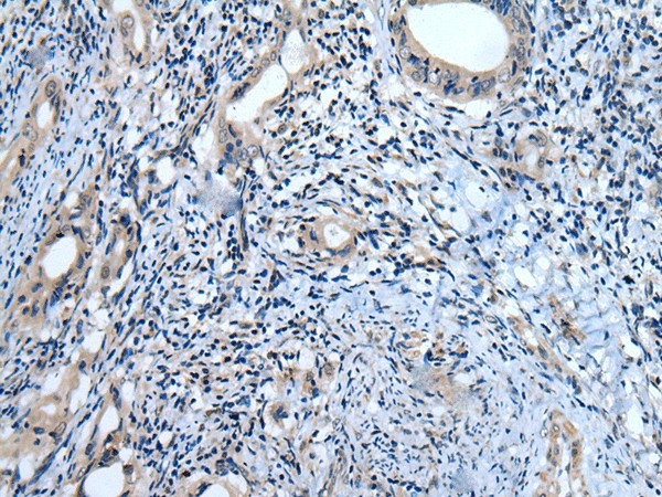 Immunohistochemistry of paraffin-embedded Human cervical cancer tissue  using USP32 Polyclonal Antibody at dilution of 1:75(?200)