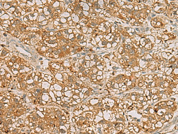 Immunohistochemistry of paraffin-embedded Human liver cancer tissue  using QDPR Polyclonal Antibody at dilution of 1:70(?200)