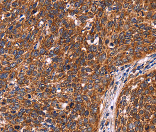 Immunohistochemistry of paraffin-embedded Human cervical cancer tissue using CCDC106 Polyclonal Antibody at dilution 1:60