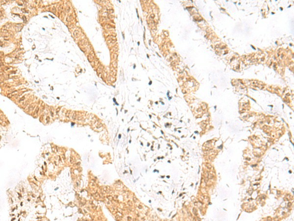 Immunohistochemistry of paraffin-embedded Human liver cancer tissue  using HES7 Polyclonal Antibody at dilution of 1:25(?200)