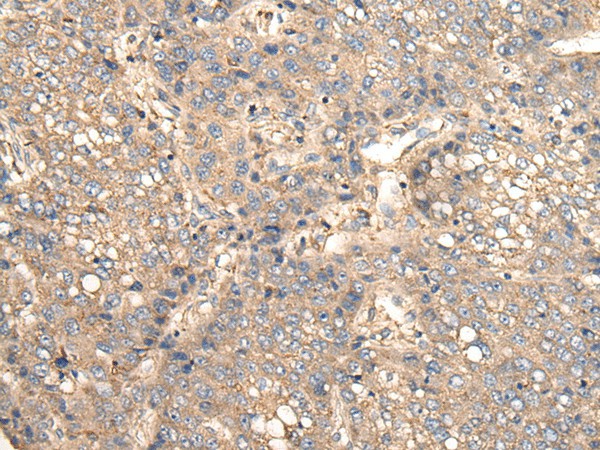 Immunohistochemistry of paraffin-embedded Human liver cancer tissue  using VTI1B Polyclonal Antibody at dilution of 1:30(?200)