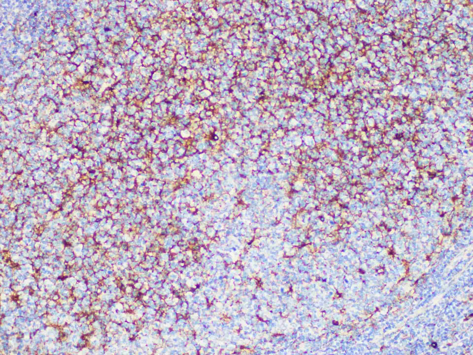 Immunohistochemistry of paraffinembedded Human melanoma tissue with CD63 Monoclonal Antibody(Antigen repaired by EDTA).