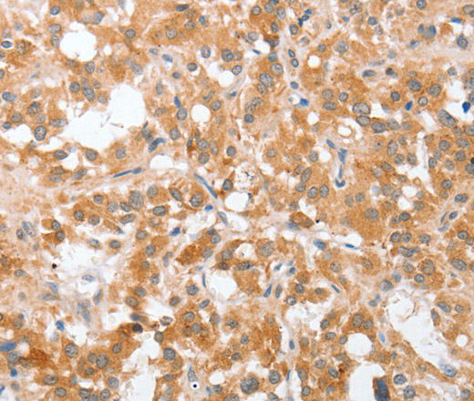 Immunohistochemistry of paraffin-embedded Human thyroid cancer tissue using cPLA2 Polyclonal Antibody at dilution 1:40