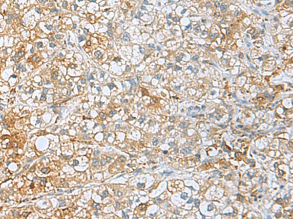 Immunohistochemistry of paraffin-embedded Human liver cancer tissue  using UCHL1 Polyclonal Antibody at dilution of 1:50(?200)