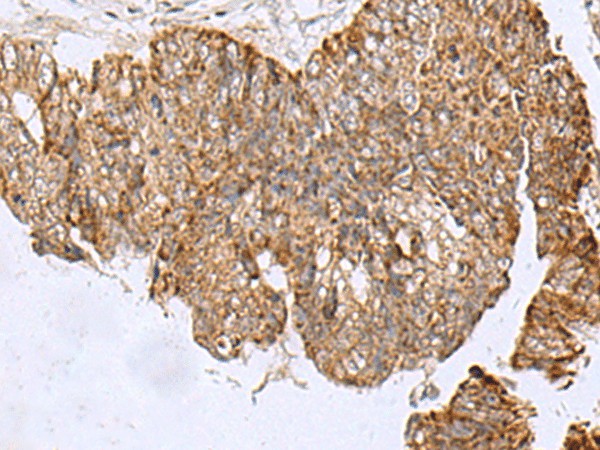 Immunohistochemistry of paraffin-embedded Human colorectal cancer tissue  using HCCS Polyclonal Antibody at dilution of 1:110(?200)