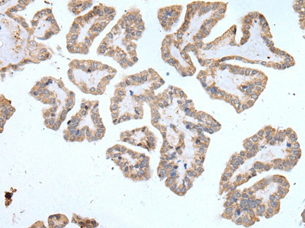 Immunohistochemistry of paraffin-embedded Human thyroid cancer tissue  using ABCD1 Polyclonal Antibody at dilution of 1:80(?200)