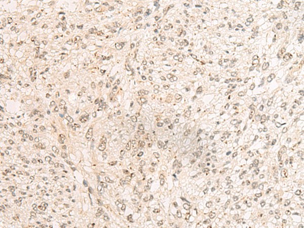 Immunohistochemistry of paraffin-embedded Human liver cancer tissue  using PAF1 Polyclonal Antibody at dilution of 1:45(?200)